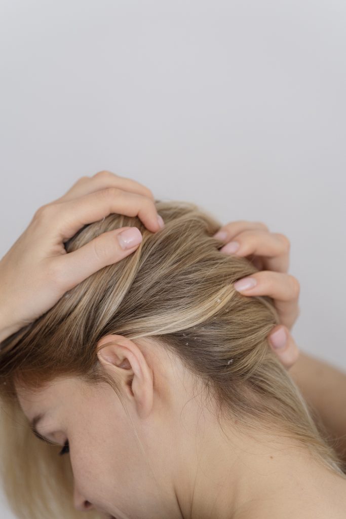 woman with dandruff issues close up